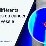 cancer vessie espérance de vie2