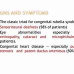 congenital rubella syndrome ppt4