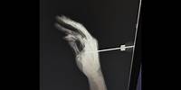 Hand Pierced with No Blood: Real or Magic | David Blaine