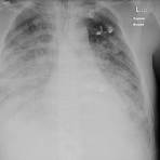 Insuficiencia respiratoria wikipedia3