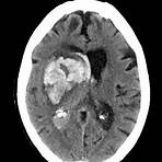 Hemorragia cerebral wikipedia1